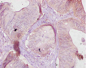 Immunohistochemistry of paraffin-embedded human colon cancer using Ces1c Antibody at dilution of 1:10Rabbit anti-Mouse Ces1c Polyclonal Antibody