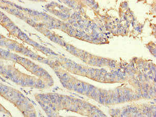 Immunohistochemistry of paraffin-embedded human endometrial cancer using PRDX2 Antibody at dilution of 1:100Rabbit anti-Human PRDX2 Polyclonal Antibody
