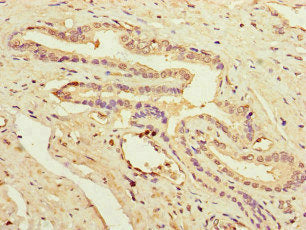 Immunohistochemistry of paraffin-embedded human prostate cancer using PRDX2 Antibody at dilution of 1:100Rabbit anti-Human PRDX2 Polyclonal Antibody