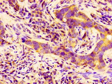 Immunohistochemistry of paraffin-embedded human pancreatic cancer using the antibody at dilution of 1:100