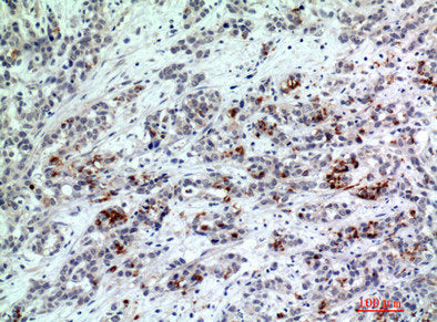 Immunohistochemical analysis of paraffin-embedded human-breast-cancer, antibody was diluted at 1:200