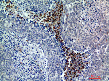 Immunohistochemical analysis of paraffin-embedded human-breast-cancer, antibody was diluted at 1:200