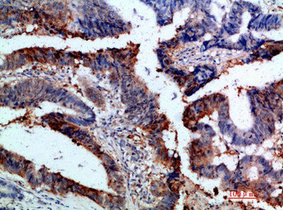 Immunohistochemical analysis of paraffin-embedded human-colon-cancer, antibody was diluted at 1:200