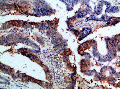 Immunohistochemical analysis of paraffin-embedded human-colon-cancer, antibody was diluted at 1:200