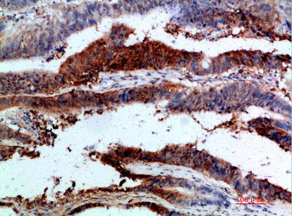 Immunohistochemical analysis of paraffin-embedded human-colon-cancer, antibody was diluted at 1:200