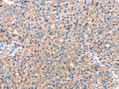 The image on the left is immunohistochemistry of paraffin-embedded Human breast cancer tissue using CAPN7 Antibody(CAPN7 Antibody) at dilution 1/20, on the right is treated with fusion protein. (Original magnification: ×200)