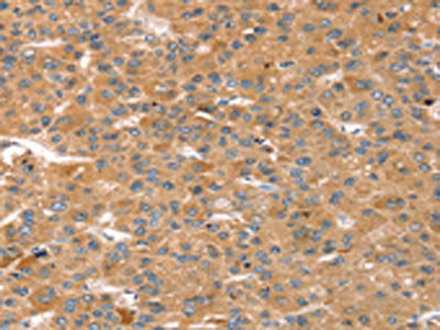 The image on the left is immunohistochemistry of paraffin-embedded Human liver cancer tissue using the antibody Antibody) at dilution 1/20, on the right is treated with fusion protein. (Original magnification: ×200)
