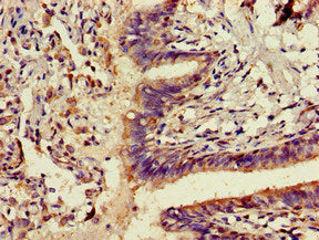 Immunohistochemistry of paraffin-embedded human lung cancer using ADK Antibody at dilution of 1:100Rabbit anti-Human ADK Polyclonal Antibody