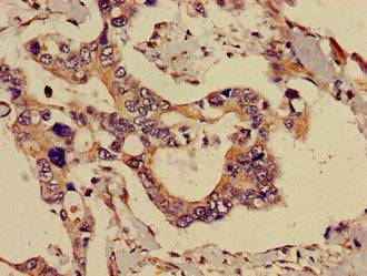 Immunohistochemistry of paraffin-embedded human pancreatic cancer using ADK Antibody at dilution of 1:100Rabbit anti-Human ADK Polyclonal Antibody