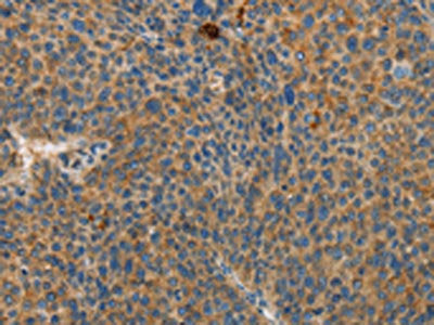 The image on the left is immunohistochemistry of paraffin-embedded Human liver cancer tissue using RPS27 Antibody(RPS27 Antibody) at dilution 1/25, on the right is treated with fusion protein. (Original magnification: ×200)Rabbit anti-Human RPS27 Polyclonal Antibody