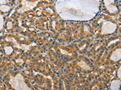 The image on the left is immunohistochemistry of paraffin-embedded Human thyroid cancer tissue using the antibody Antibody) at dilution 1/25, on the right is treated with fusion protein. (Original magnification: ×200)Rabbit anti-Human RPS27 Polyclonal Antibody
