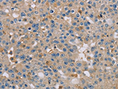 The image on the left is immunohistochemistry of paraffin-embedded Human breast cancer tissue using CLIC1 Antibody(CLIC1 Antibody) at dilution 1/30, on the right is treated with fusion protein. (Original magnification: ×200)Rabbit anti-Human CLIC1 Polyclonal Antibody