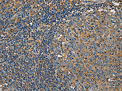 The image on the left is immunohistochemistry of paraffin-embedded Human tonsil tissue using the antibody Antibody) at dilution 1/30, on the right is treated with fusion protein. (Original magnification: ×200)Rabbit anti-Human CLIC1 Polyclonal Antibody