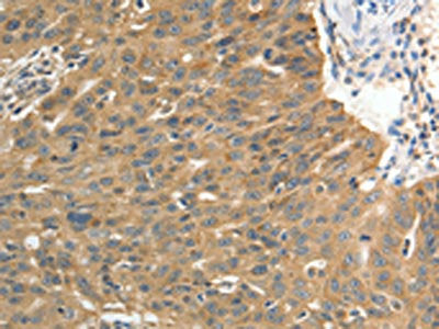 The image on the left is immunohistochemistry of paraffin-embedded Human ovarian cancer tissue using PTP4A2 Antibody(PTP4A2 Antibody) at dilution 1/25, on the right is treated with fusion protein. (Original magnification: ×200)Rabbit anti-Human PTP4A2 Polyclonal Antibody