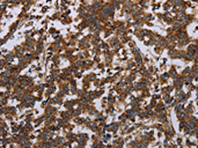The image on the left is immunohistochemistry of paraffin-embedded Human liver cancer tissue using GDF2 Antibody(GDF2 Antibody) at dilution 1/40, on the right is treated with synthetic peptide. (Original magnification: ×200)Rabbit anti-Human GDF2 Polyclonal Antibody