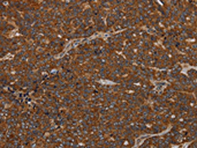 The image on the left is immunohistochemistry of paraffin-embedded Human ovarian cancer tissue using the antibody Antibody) at dilution 1/40, on the right is treated with synthetic peptide. (Original magnification: ×200)Rabbit anti-Human GDF2 Polyclonal Antibody