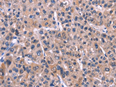 The image on the left is immunohistochemistry of paraffin-embedded Human liver cancer tissue using XPO1 Antibody(XPO1 Antibody) at dilution 1/25, on the right is treated with fusion protein. (Original magnification: ×200)Rabbit anti-Human XPO1 Polyclonal Antibody