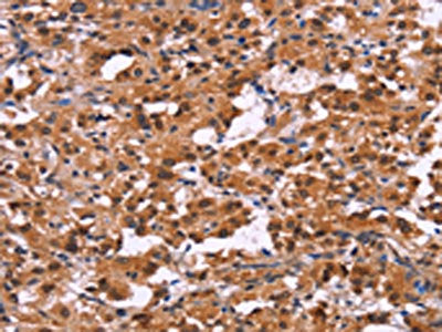 The image on the left is immunohistochemistry of paraffin-embedded Human thyroid cancer tissue using the antibody Antibody) at dilution 1/25, on the right is treated with fusion protein. (Original magnification: ×200)Rabbit anti-Human XPO1 Polyclonal Antibody