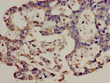 Immunohistochemistry analysis of human pancreatic cancer using TRBV7-9 Antibody at dilution of 1:100Rabbit anti-Human TCRB Polyclonal Antibody
