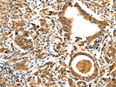 The image on the left is immunohistochemistry of paraffin-embedded Human gastric cancer tissue using TPM2 Antibody(TPM2 Antibody) at dilution 1/25, on the right is treated with synthetic peptide. (Original magnification: ×200)Rabbit anti-Human TPM2 Polyclonal Antibody