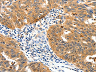 The image on the left is immunohistochemistry of paraffin-embedded Human ovarian cancer tissue using the antibody Antibody) at dilution 1/25, on the right is treated with synthetic peptide. (Original magnification: ×200)Rabbit anti-Human TPM2 Polyclonal Antibody