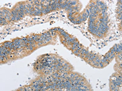 The image on the left is immunohistochemistry of paraffin-embedded Human colon cancer tissue using ARHGEF9 Antibody(ARHGEF9 Antibody) at dilution 1/50, on the right is treated with fusion protein. (Original magnification: ×200)Rabbit anti-Human ARHGEF9 Polyclonal Antibody