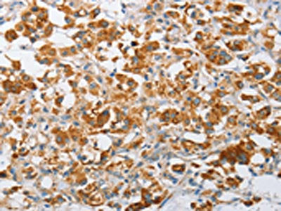 The image on the left is immunohistochemistry of paraffin-embedded Human thyroid cancer tissue using the antibody Antibody) at dilution 1/50, on the right is treated with fusion protein. (Original magnification: ×200)Rabbit anti-Human ARHGEF9 Polyclonal Antibody