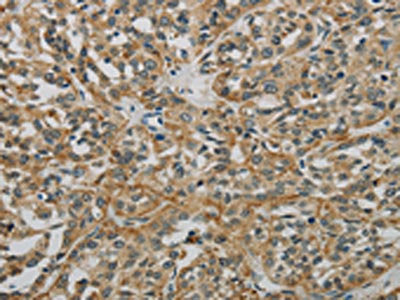 The image on the left is immunohistochemistry of paraffin-embedded Human esophagus cancer tissue using E2F6 Antibody(E2F6 Antibody) at dilution 1/60, on the right is treated with fusion protein. (Original magnification: ×200)Rabbit anti-Human E2F6 Polyclonal Antibody