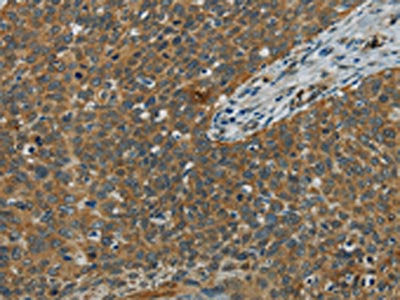 The image on the left is immunohistochemistry of paraffin-embedded Human cervical cancer tissue using the antibody Antibody) at dilution 1/60, on the right is treated with fusion protein. (Original magnification: ×200)Rabbit anti-Human E2F6 Polyclonal Antibody