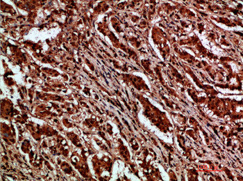 Immunohistochemical analysis of paraffin-embedded human-breast-cancer, antibody was diluted at 1:200Rabbit anti-Human CTNND1 Polyclonal Antibody