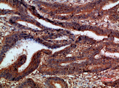 Immunohistochemical analysis of paraffin-embedded human-colon-cancer, antibody was diluted at 1:200Rabbit anti-Human CTNND1 Polyclonal Antibody
