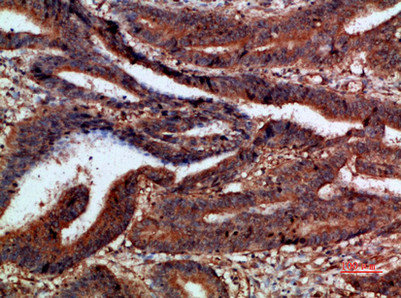 Immunohistochemical analysis of paraffin-embedded human-colon-cancer, antibody was diluted at 1:200Rabbit anti-Human CTNND1 Polyclonal Antibody