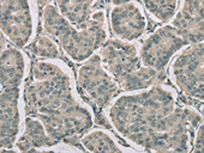 The image on the left is immunohistochemistry of paraffin-embedded Human breast cancer tissue using RNASE3 Antibody(RNASE3 Antibody) at dilution 1/20, on the right is treated with fusion protein. (Original magnification: ×200)Rabbit anti-Human RNASE3 Polyclonal Antibody