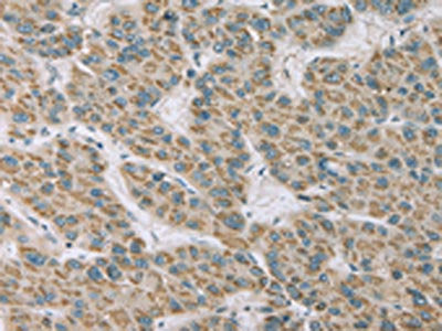 The image on the left is immunohistochemistry of paraffin-embedded Human liver cancer tissue using the antibody Antibody) at dilution 1/20, on the right is treated with fusion protein. (Original magnification: ×200)Rabbit anti-Human RNASE3 Polyclonal Antibody