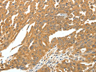 The image on the left is immunohistochemistry of paraffin-embedded Human ovarian cancer tissue using SKP1 Antibody(SKP1 Antibody) at dilution 1/30, on the right is treated with fusion protein. (Original magnification: ×200)Rabbit anti-Human SKP1 Polyclonal Antibody