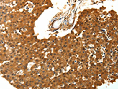 The image on the left is immunohistochemistry of paraffin-embedded Human breast cancer tissue using the antibody Antibody) at dilution 1/30, on the right is treated with fusion protein. (Original magnification: ×200)Rabbit anti-Human SKP1 Polyclonal Antibody