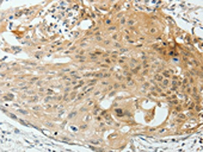 The image on the left is immunohistochemistry of paraffin-embedded Human cervical cancer tissue using VEGFA Antibody(VEGFA Antibody) at dilution 1/25, on the right is treated with synthetic peptide. (Original magnification: ×200)Rabbit anti-Human VEGFA Polyclonal Antibody
