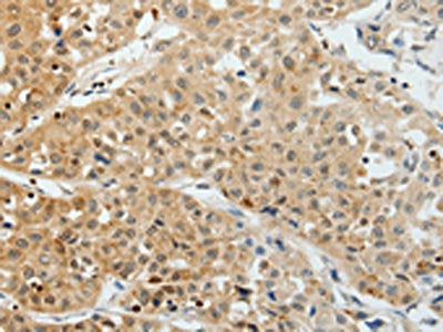 The image on the left is immunohistochemistry of paraffin-embedded Human lung cancer tissue using the antibody Antibody) at dilution 1/25, on the right is treated with synthetic peptide. (Original magnification: ×200)Rabbit anti-Human VEGFA Polyclonal Antibody