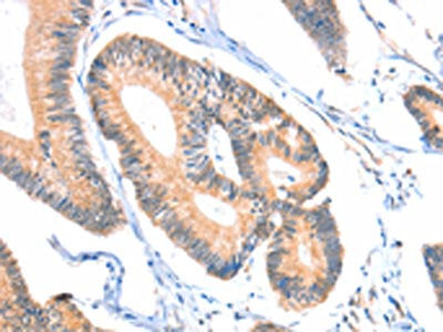 The image on the left is immunohistochemistry of paraffin-embedded Human colon cancer tissue using ACSM5 Antibody(ACSM5 Antibody) at dilution 1/20, on the right is treated with fusion protein. (Original magnification: ×200)