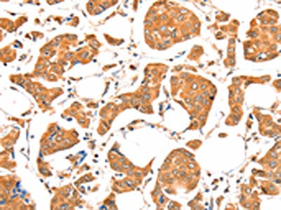The image on the left is immunohistochemistry of paraffin-embedded Human breast cancer tissue using the antibody Antibody) at dilution 1/20, on the right is treated with fusion protein. (Original magnification: ×200)