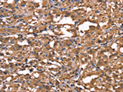 The image on the left is immunohistochemistry of paraffin-embedded Human thyroid cancer tissue using TDP2 Antibody(TDP2 Antibody) at dilution 1/40, on the right is treated with synthetic peptide. (Original magnification: ×200)Rabbit anti-Human TDP2 Polyclonal Antibody