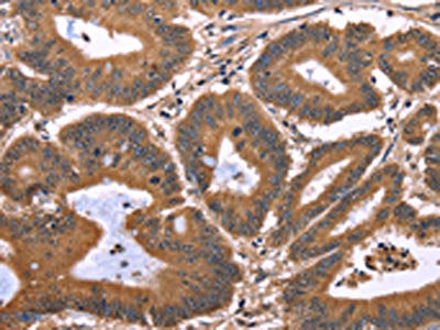 The image on the left is immunohistochemistry of paraffin-embedded Human colon cancer tissue using the antibody Antibody) at dilution 1/40, on the right is treated with synthetic peptide. (Original magnification: ×200)Rabbit anti-Human TDP2 Polyclonal Antibody