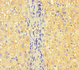 Immunohistochemistry of paraffin-embedded human liver cancer using the antibody at dilution of 1:100