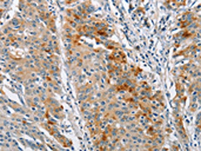 The image on the left is immunohistochemistry of paraffin-embedded Human gastric cancer tissue using BCL10 Antibody(BCL10 Antibody) at dilution 1/40, on the right is treated with fusion protein. (Original magnification: ×200)
