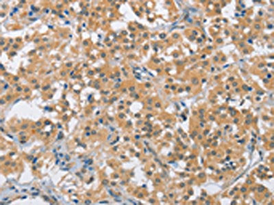 The image on the left is immunohistochemistry of paraffin-embedded Human thyroid cancer tissue using the antibody Antibody) at dilution 1/40, on the right is treated with fusion protein. (Original magnification: ×200)