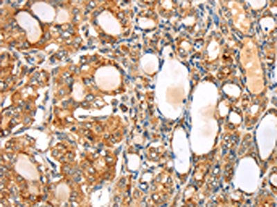 The image on the left is immunohistochemistry of paraffin-embedded Human thyroid cancer tissue using SLC8B1 Antibody(SLC8B1 Antibody) at dilution 1/20, on the right is treated with synthetic peptide. (Original magnification: ×200)