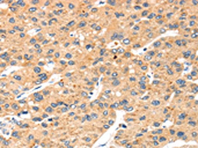 The image on the left is immunohistochemistry of paraffin-embedded Human liver cancer tissue using the antibody Antibody) at dilution 1/20, on the right is treated with synthetic peptide. (Original magnification: ×200)