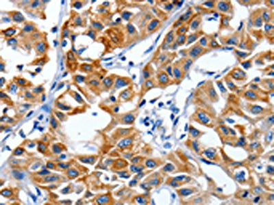 The image on the left is immunohistochemistry of paraffin-embedded Human lung cancer tissue using IGF2BP1 Antibody(IGF2BP1 Antibody) at dilution 1/40, on the right is treated with synthetic peptide. (Original magnification: ×200)Rabbit anti-Human IGF2BP1 Polyclonal Antibody