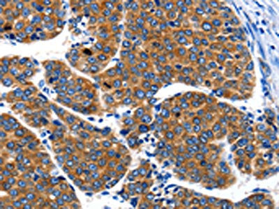 The image on the left is immunohistochemistry of paraffin-embedded Human liver cancer tissue using the antibody Antibody) at dilution 1/40, on the right is treated with synthetic peptide. (Original magnification: ×200)