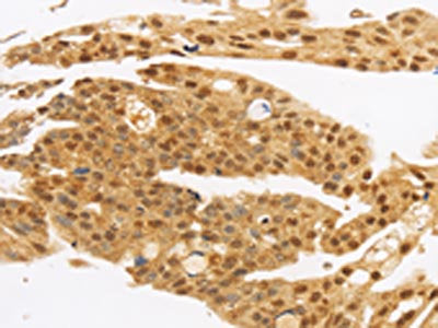 The image on the left is immunohistochemistry of paraffin-embedded Human gastic cancer tissue using MYC Antibody(c-Myc Tag Antibody) at dilution 1/10, on the right is treated with synthetic peptide. (Original magnification: ×200)Rabbit anti-Human MYC Polyclonal Antibody